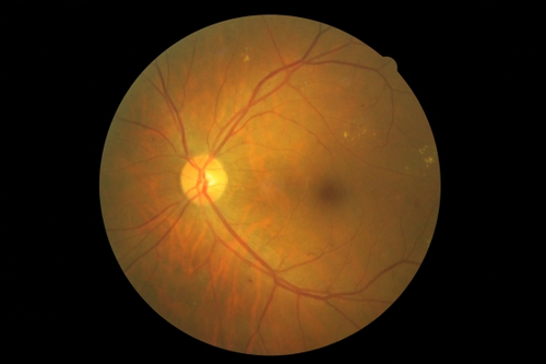 background diabetic retinopathy, BDR(背景性糖尿病視網膜病變)